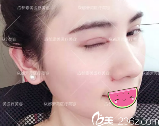 楊迪切開雙眼皮術(shù)后半個月美照 楊迪切開雙眼皮術(shù)后半個月美照