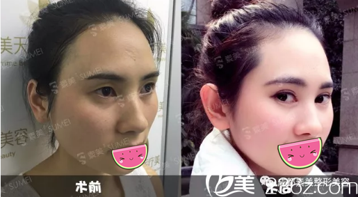 <!--<i data=20240703-sp></i>-->楊迪切開雙眼皮術(shù)前術(shù)后對比 <!--<i data=20240703-sp></i>-->楊迪切開雙眼皮術(shù)前術(shù)后對比