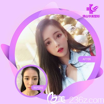 佛山華美雷朝勇隆鼻失敗修復(fù)案例 佛山華美雷朝勇隆鼻失敗修復(fù)案例