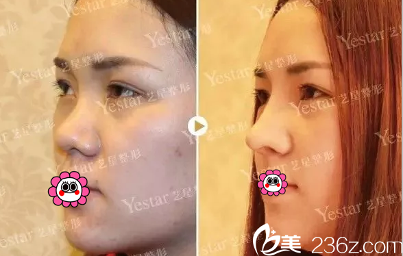 北京藝星醫(yī)療美容醫(yī)院谷亦涵注射隆鼻效果 北京藝星醫(yī)療美容醫(yī)院谷亦涵注射隆鼻效果