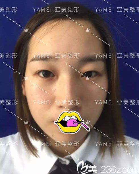 作雙眼皮手術(shù)前照片 作雙眼皮手術(shù)前照片