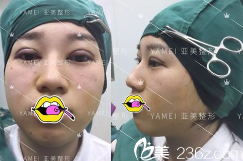 在亞美剛做完雙眼皮的照片 在亞美剛做完雙眼皮的照片