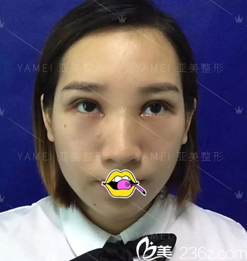 在亞美做完雙眼皮術(shù)后1天恢復(fù)照 在亞美做完雙眼皮術(shù)后1天恢復(fù)照