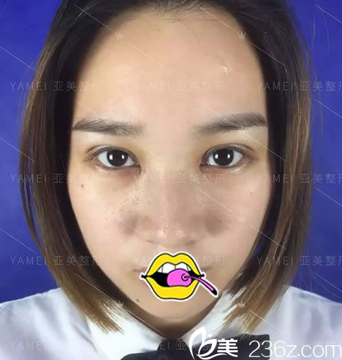 金華亞美胡華兵雙眼皮<span style= 金華亞美胡華兵雙眼皮<span style=