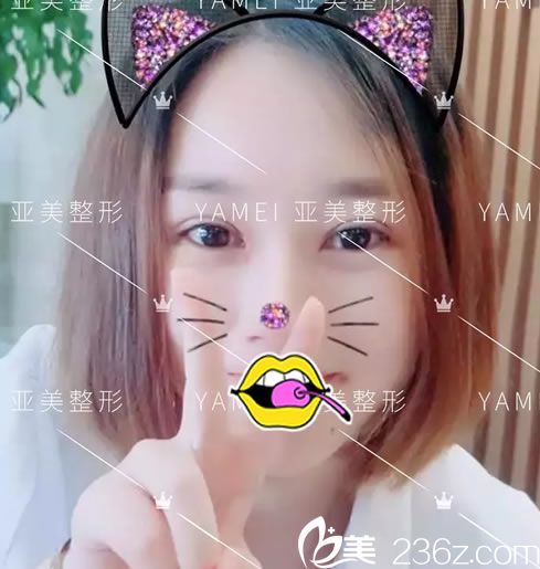 2018年6月4日在金華亞美接受胡華兵院長(zhǎng)全切雙眼皮手術(shù) 現(xiàn)更新術(shù)后恢復(fù)效果