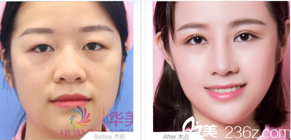 佛山華美雷朝勇做的雙眼皮案例對比圖 佛山華美雷朝勇做的雙眼皮案例對比圖