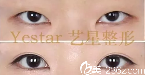 北京藝星醫(yī)療美容醫(yī)院慕昕雙眼皮案例 北京藝星醫(yī)療美容醫(yī)院慕昕雙眼皮案例