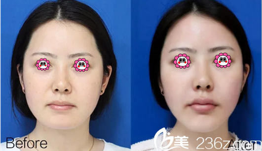 北京藝星醫(yī)療美容醫(yī)院胡錦幸注射案例 北京藝星醫(yī)療美容醫(yī)院胡錦幸注射案例