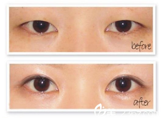 阜陽東方美萊塢高士乾雙眼皮效果怎么樣 阜陽東方美萊塢高士乾雙眼皮效果怎么樣