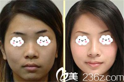 阜陽東方美萊塢高士乾隆鼻效果 阜陽東方美萊塢高士乾隆鼻效果