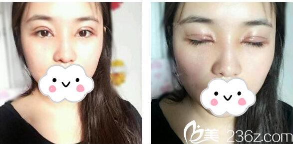 珠海九龍整形美容醫(yī)院梁富榮醫(yī)生做的雙眼皮案例兩天效果圖