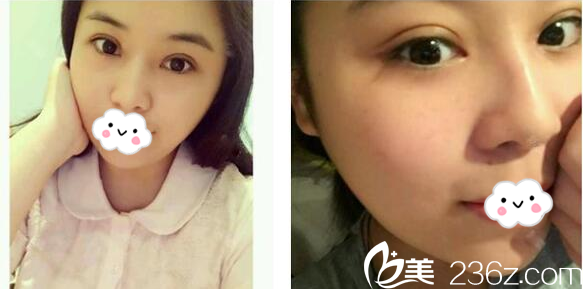 珠海哪里割雙眼皮好？珠海九龍整形美容醫(yī)院梁富榮醫(yī)生雙眼皮案例分享