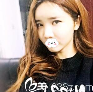 術(shù)后一個(gè)月效果