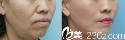 StarM整形外科去法令紋案例 StarM整形外科去法令紋案例