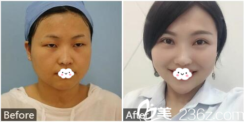 去佛山曙光金子整形醫(yī)院找何宜新院長(zhǎng)做的切開(kāi)雙眼皮案例圖