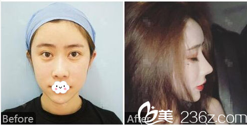 佛山曙光金子整形美容醫(yī)院何宜新院長(zhǎng)鼻綜合隆鼻案例