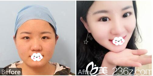 佛山曙光金子整形美容醫(yī)院何宜新定點埋線雙眼皮案例