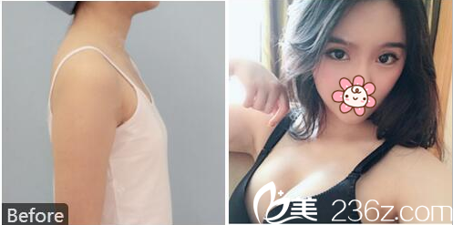佛山曙光金子整形美容醫(yī)院做隆胸怎么樣？看何宜新假體隆胸案例