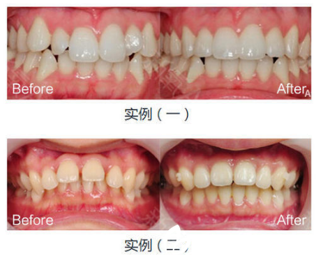 佛山曙光金子整形美容醫(yī)院劉曉勤牙齒矯正案例