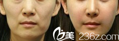 韓國Star M整形外科醫(yī)院自體脂肪填充蘋果肌案例 韓國Star M整形外科醫(yī)院自體脂肪填充蘋果肌案例