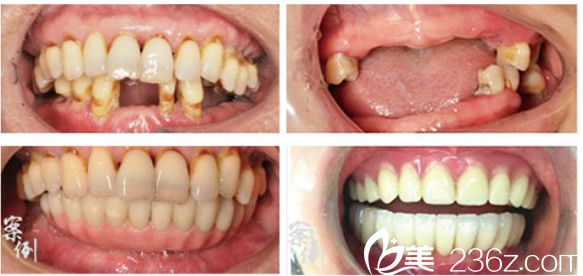 合肥壹加壹牙齒種植案例前后對(duì)比照