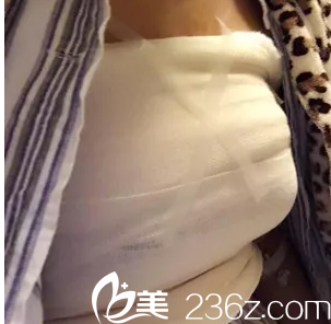 韓國Star M整形外科脂肪豐胸術(shù)后三天效果 韓國Star M整形外科脂肪豐胸術(shù)后三天效果