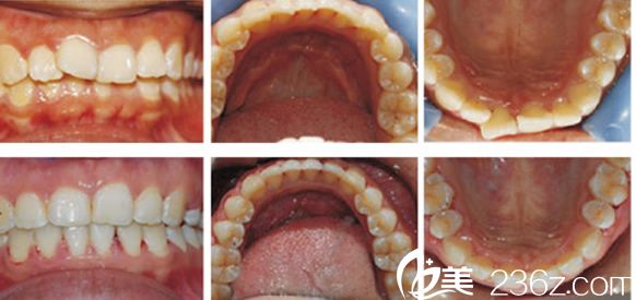 合肥壹加壹牙齒矯正案例恢復(fù)過(guò)程圖