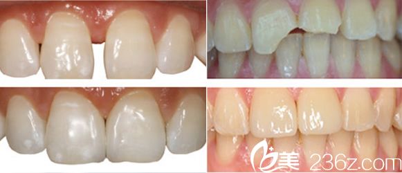 合肥壹加壹牙齒美學(xué)修復(fù)前后對(duì)比圖片