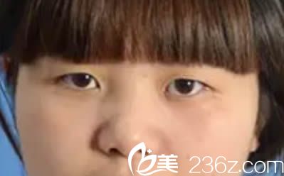 在泉州億星整形醫(yī)院做雙眼皮和隆鼻術(shù)前照 在泉州億星整形醫(yī)院做雙眼皮和隆鼻術(shù)前照