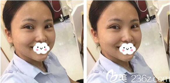 去佛山曙光金子整形醫(yī)院找何宜新做完雙眼皮三天了 去佛山曙光金子整形醫(yī)院找何宜新做完雙眼皮三天了