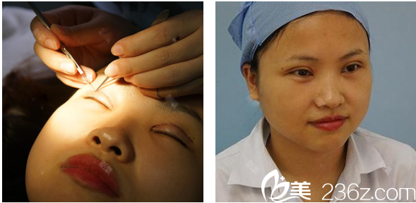 切開雙眼皮第7天來佛山曙光金子整形醫(yī)院拆線 切開雙眼皮第7天來佛山曙光金子整形醫(yī)院拆線