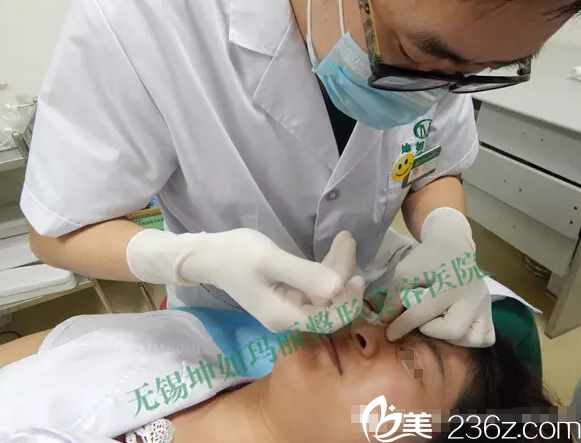 鼻背部注射玻尿酸 鼻背部注射玻尿酸