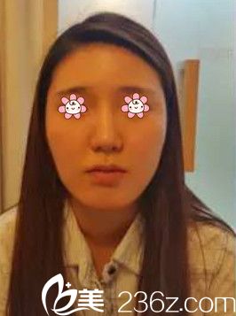 去韓國(guó)NEO整形外科前的我 去韓國(guó)NEO整形外科前的我