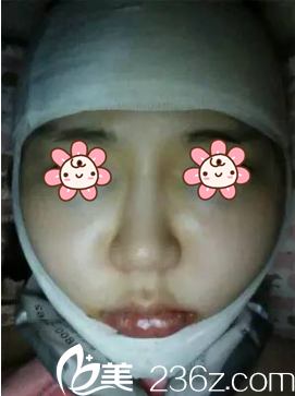 韓國(guó)NEO整形醫(yī)院下頜角整形術(shù)后第3天 韓國(guó)NEO整形醫(yī)院下頜角整形術(shù)后第3天