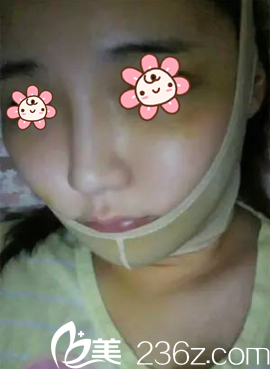 樸正日院長(zhǎng)墊下巴術(shù)后一周 樸正日院長(zhǎng)墊下巴術(shù)后一周