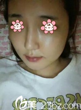 樸正日顴骨縮小加下頜角加墊下巴術(shù)后十天 樸正日顴骨縮小加下頜角加墊下巴術(shù)后十天