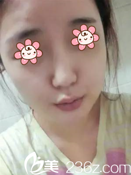 韓國(guó)NEO整形外科顴骨縮小+下頜角+墊下巴術(shù)后15天 韓國(guó)NEO整形外科顴骨縮小+下頜角+墊下巴術(shù)后15天