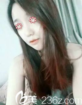 樸正日院長(zhǎng)顴骨縮小術(shù)后一個(gè)月 樸正日院長(zhǎng)顴骨縮小術(shù)后一個(gè)月