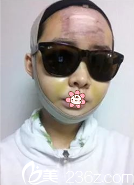 姬廣翰雙鄂+面部輪廓術后10天 