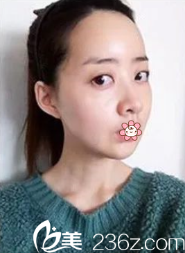 我在重慶美侖美奐做完雙鄂+面部輪廓40天