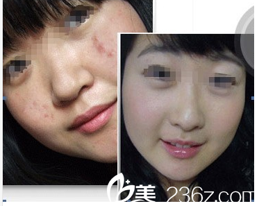 沈培興醫(yī)生祛痘案例對比