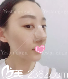 連凱峰鼻綜合術(shù)后13天效果