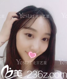 北京藝星連凱峰鼻綜合術(shù)后13天效果