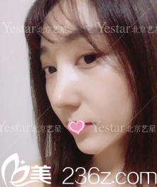 連凱峰鼻綜合術(shù)后28天效果