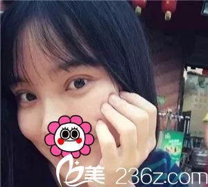 術(shù)后一周雙眼皮恢復(fù)中