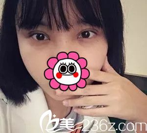 術(shù)后十天雙眼皮拆線恢復(fù)