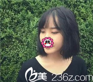 拆完線后雙眼皮恢復(fù)