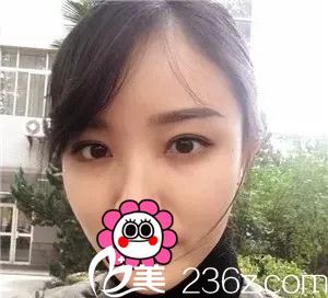 5mm?7mm?9mm? 泰州華美雙眼皮親身體驗(yàn)告訴你想要自然寬雙眼皮到底選幾毫米合適