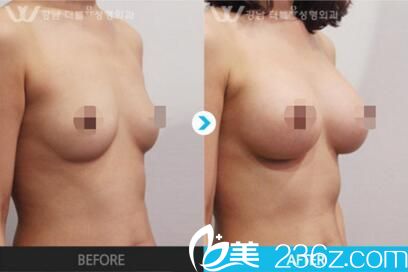 吳赫守胸部整形前后對比