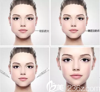 咬肌大造成四方臉？長(zhǎng)春銘尚瘦臉除皺瘦臉1100元起